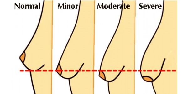 Điều lầm tưởng về ngực chảy xệ